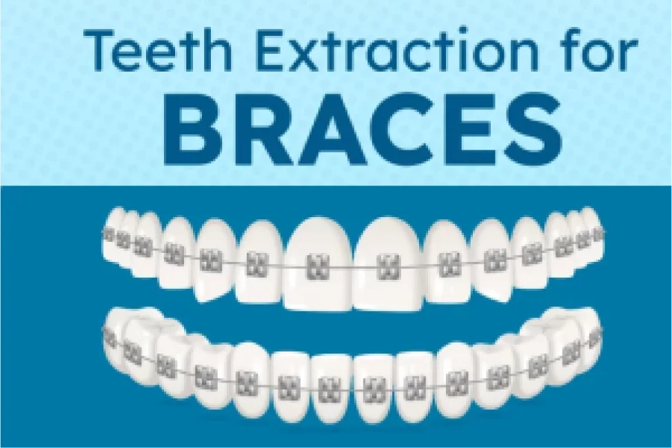 Teeth Extraction for Braces